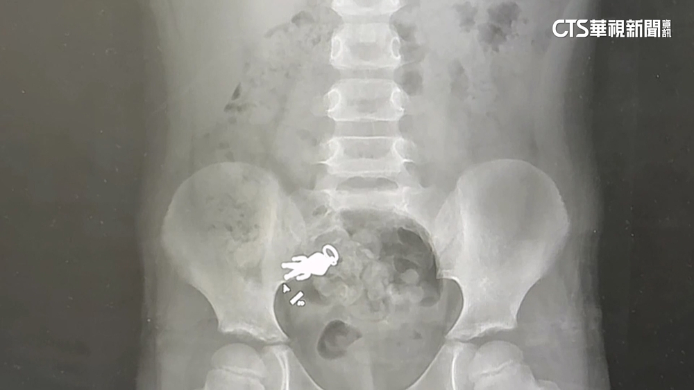 宜蘭童誤食「超人公仔」照X光現身！　網歪樓：附身合體