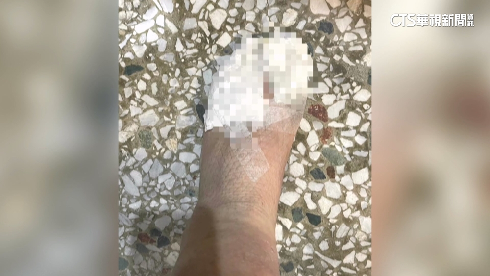 災區奔波2腳趾磨出洞　大安村長感染蜂窩性組織炎