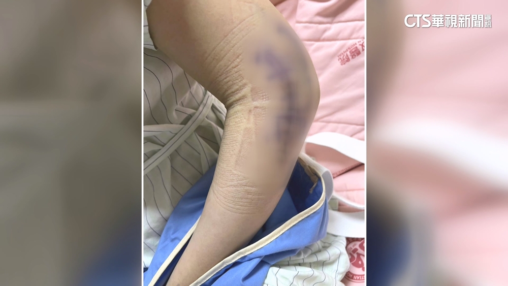 八卦山危險滑梯再傳意外　27歲女摔斷手開刀噴6萬