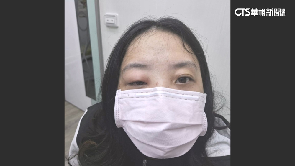 戴全罩式安全帽「竟遭蜂螫」　女眼皮紅腫.視力下降急就醫